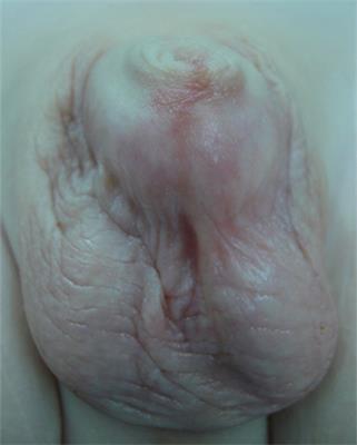Megaprepuce Reconstruction: A Single Center Experience